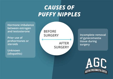 what causes puffy nipples|The Complete Guide to Puffy Nipples